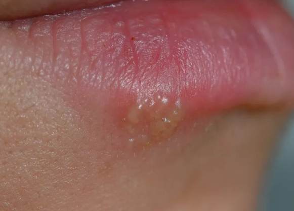 嘴唇水泡原因