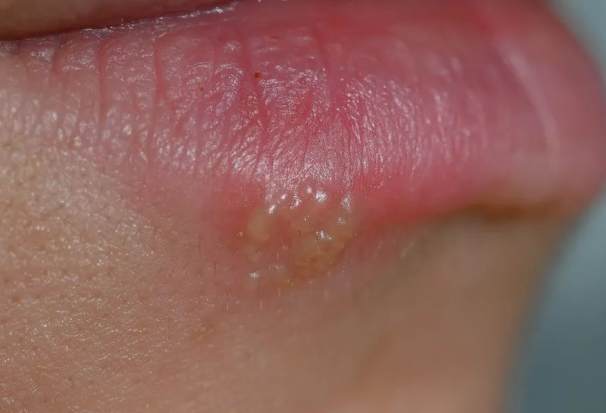 嘴唇水泡原因