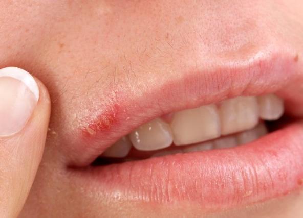 唇皰疹治療方法