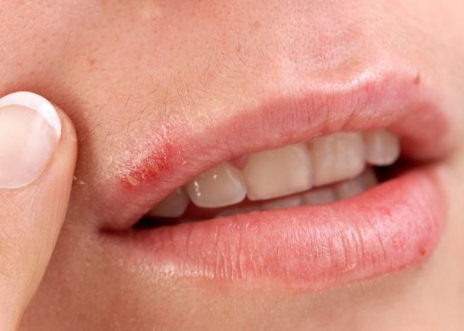 唇皰疹飲食指南