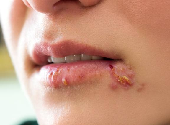唇邊水泡治療