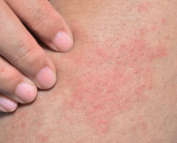 過敏不能吃的食物