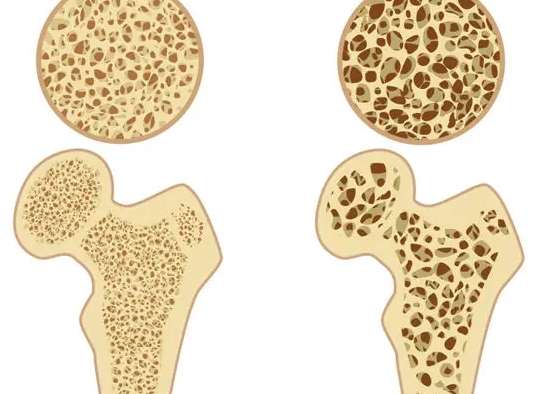 骨質疏鬆治療
