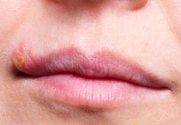 嘴唇水泡原因