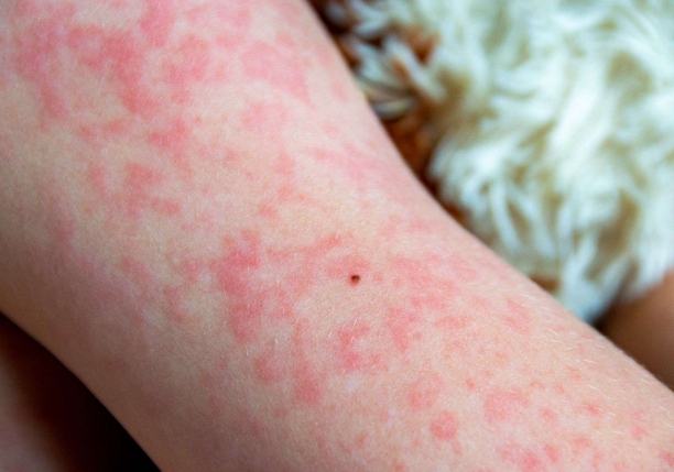 蕁麻疹飲食禁忌