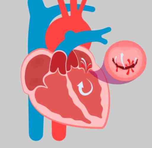 二尖瓣脫垂飲食禁忌