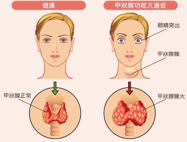 甲狀腺亢進 吃蛋