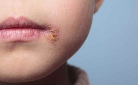 唇皰疹結痂期症狀