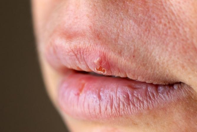 嘴唇水泡原因