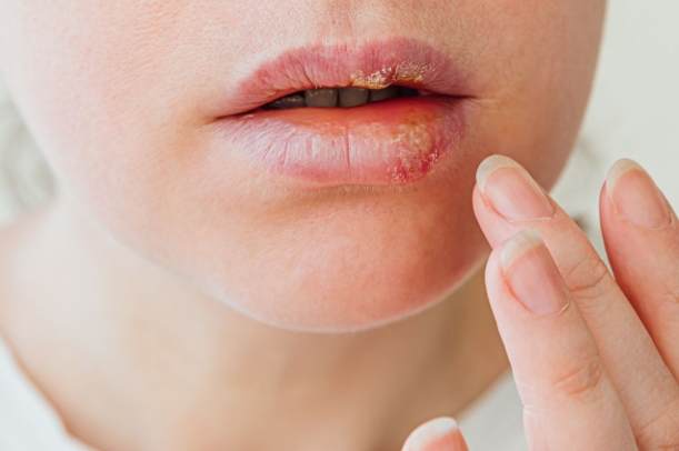 唇皰疹飲食禁忌