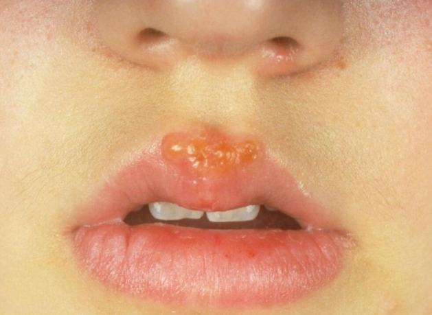 嘴唇水泡原因