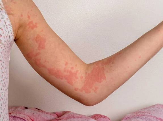 皮膚過敏飲食禁忌