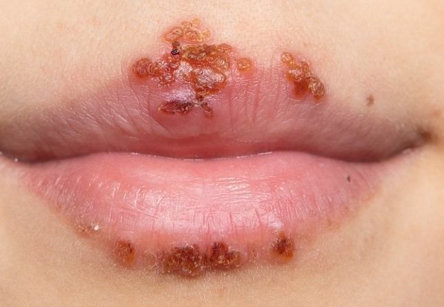 唇皰疹治療方法