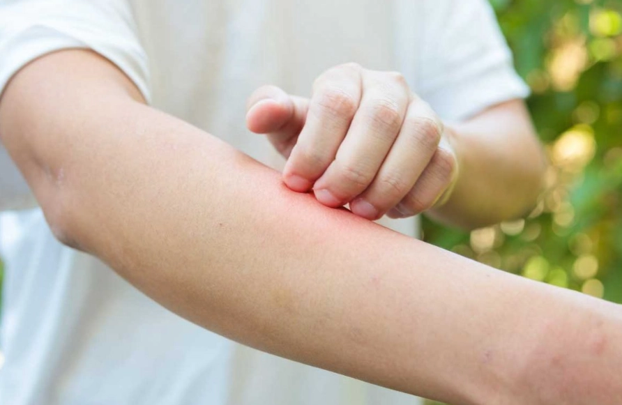 食物過敏紅疹照護