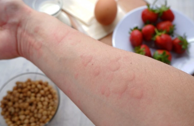 嬰兒過敏紅疹恢復時間