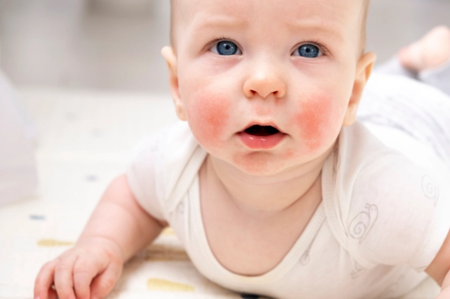 寶寶食物過敏紅疹