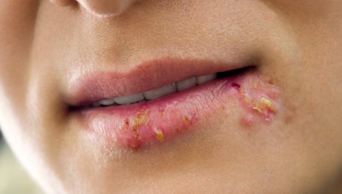 唇皰疹治療