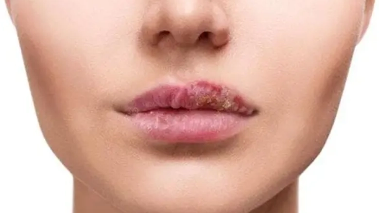 唇皰疹誘發因素