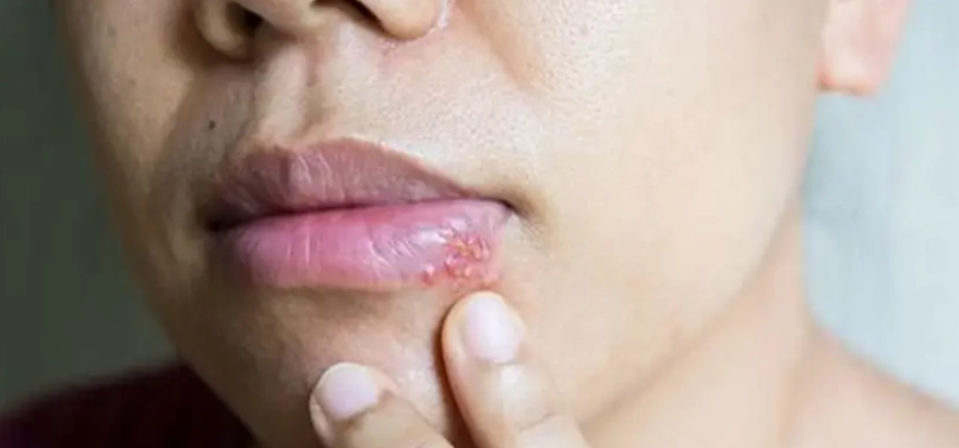 唇皰疹誘發因素