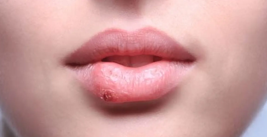 唇皰疹自癒