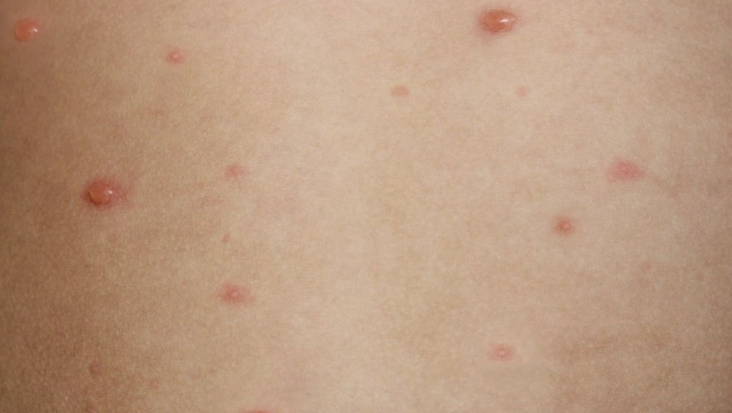 唇皰疹治療科別