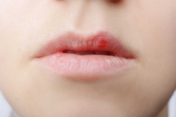唇皰疹自癒