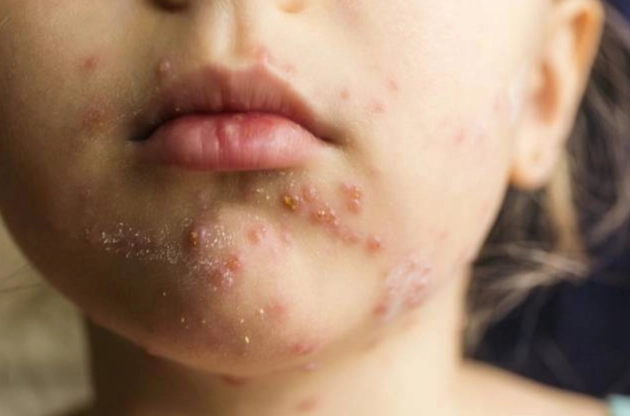 食物過敏紅疹照護