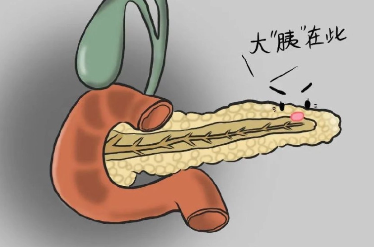 急性胰臟炎禁食