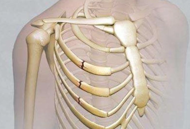 肋骨骨折飲食禁忌