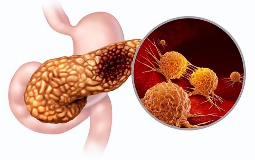 胰臟炎禁食時間