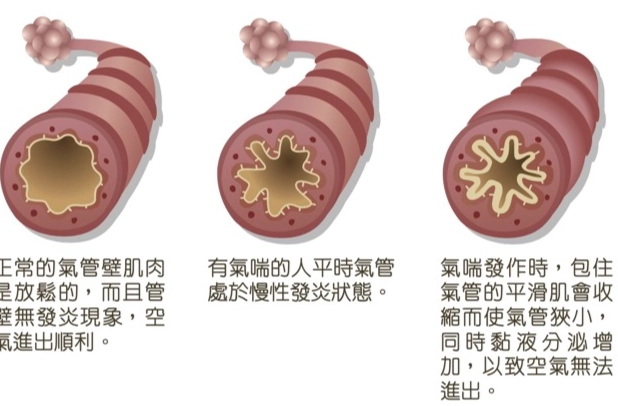 氣喘適合的運動